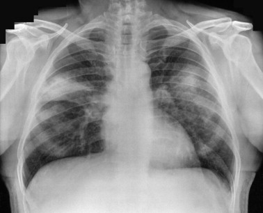 X-ray