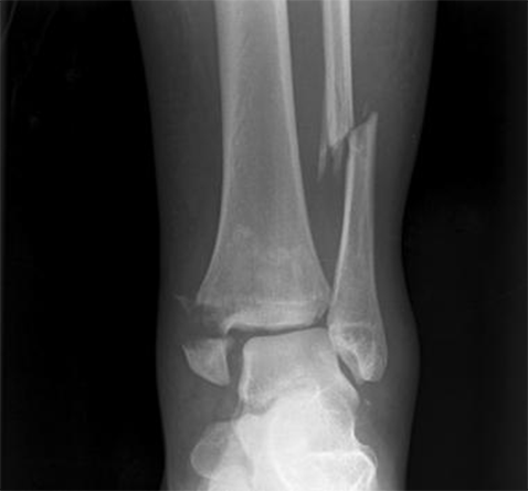 X-ray